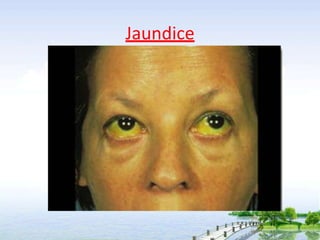 Jaundice
 