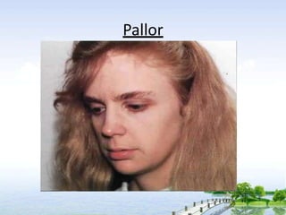 Pallor
 