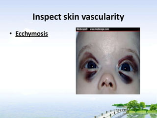 Inspect skin vascularity
• Ecchymosis
 