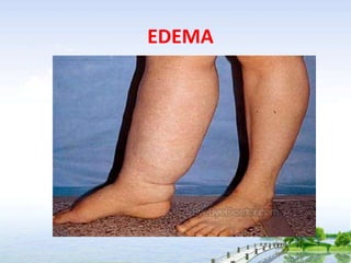 EDEMA
 