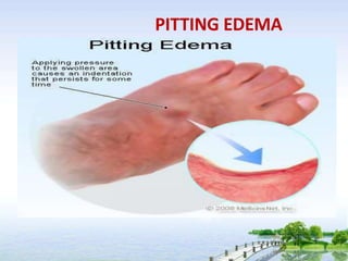 PITTING EDEMA
 