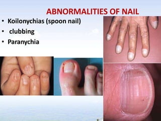 ABNORMALITIES OF NAIL
• Koilonychias (spoon nail)
• clubbing
• Paranychia
 