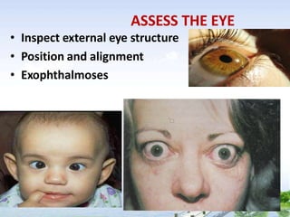 ASSESS THE EYE
• Inspect external eye structure
• Position and alignment
• Exophthalmoses
 