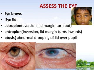 ASSESS THE EYE
• Eye brows
• Eye lid :
• ectropion(eversion ,lid margin turn out)
• entropion(inversion, lid margin turns inwards)
• ptosis( abnormal drooping of lid over pupil
 