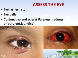 ASSESS THE EYE
• Eye lashes : sty.
• Eye balls
• Conjunctiva and sclera{ Paleness, redness
or purulent,jaundice}
 