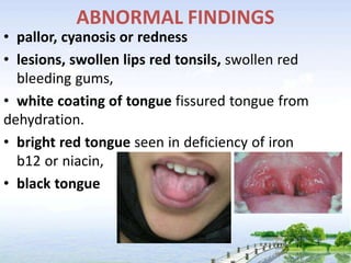 ABNORMAL FINDINGS
• pallor, cyanosis or redness
• lesions, swollen lips red tonsils, swollen red
bleeding gums,
• white coating of tongue fissured tongue from
dehydration.
• bright red tongue seen in deficiency of iron
b12 or niacin,
• black tongue
 