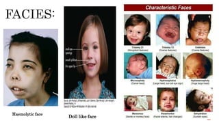 Haemolytic face
Doll like face
 