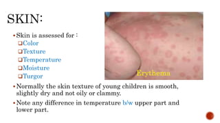 Skin is assessed for :
Color
Texture
Temperature
Moisture
Turgor
Normally the skin texture of young children is smooth,
slightly dry and not oily or clammy.
Note any difference in temperature b/w upper part and
lower part.
Erythema
 