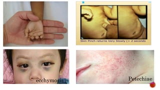Petechiaeecchymosis
 