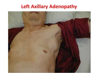 Left Axillary Adenopathy
 
