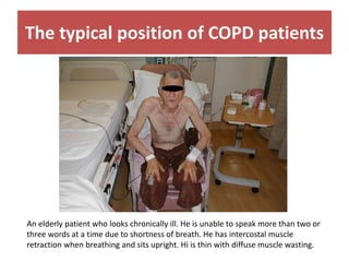 The typical position of COPD patients
An elderly patient who looks chronically ill. He is unable to speak more than two or
three words at a time due to shortness of breath. He has intercostal muscle
retraction when breathing and sits upright. Hi is thin with diffuse muscle wasting.
 