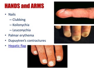 HANDS and ARMS
• Nails
– Clubbing
– Koilonychia
– Leuconychia
• Palmar erythema
• Dupuytren’s contractures
• Hepatic flap
 