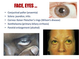 • Conjuctival pallor (anaemia)
• Sclera: jaundice, iritis
• Cornea: Kaiser Fleischer’s rings (Wilson’s disease)
• Xanthelasma (primary biliary cirrhosis)
• Parotid enlargement (alcohol)
FACE, EYES …
 