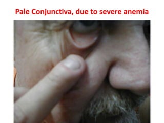 Pale Conjunctiva, due to severe anemia
 