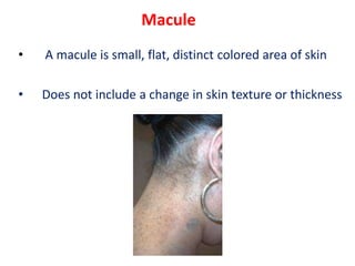 Macule
• A macule is small, flat, distinct colored area of skin
• Does not include a change in skin texture or thickness
 