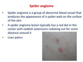 Spider angioma
• Spider angioma is a group of abnormal blood vessel that
produces the appearance of a spider-web on the surface
of the skin
• A spider angioma lesion typically has a red dot in the
center with reddish extensions radiating out for some
distance around it
• Liver palms
 