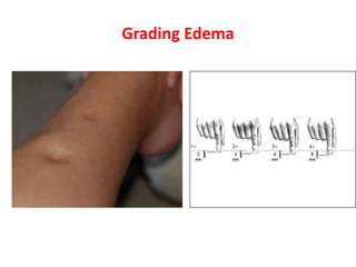 Grading Edema
 