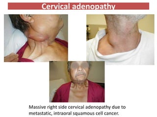 Cervical adenopathy
Massive right side cervical adenopathy due to
metastatic, intraoral squamous cell cancer.
 