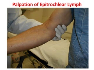 Palpation of Epitrochlear Lymph
Nodes
 