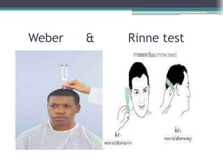 Weber & Rinne test
 