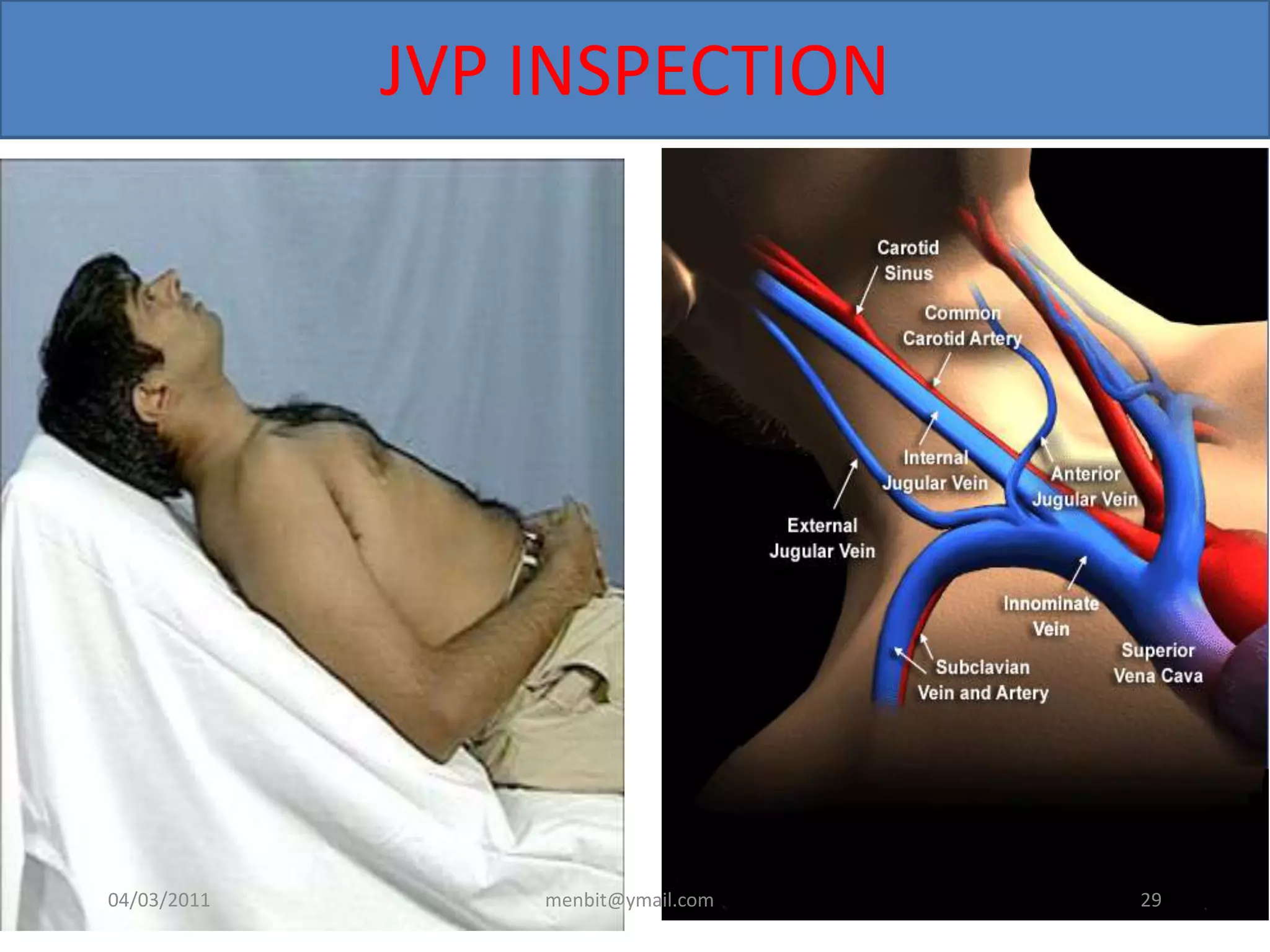 JVP INSPECTION
04/03/2011 menbit@ymail.com 29
 