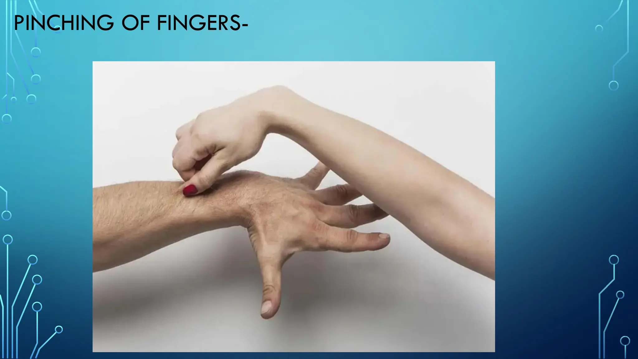 PINCHING OF FINGERS-
 