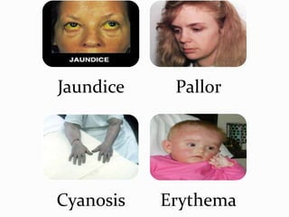 Jaundice Pallor
Cyanosis Erythema
 