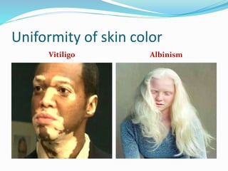 Uniformity of skin color
Vitiligo Albinism
 