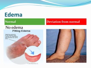 Edema
Normal Deviation from normal
No edema
 