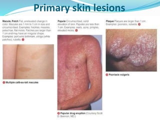 Primary skin lesions
 