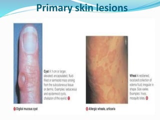 Primary skin lesions
 