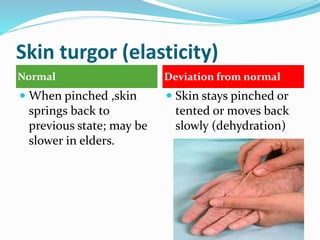 Skin turgor (elasticity)
Normal Deviation from normal
 When pinched ,skin
springs back to
previous state; may be
slower in elders.
 Skin stays pinched or
tented or moves back
slowly (dehydration)
 