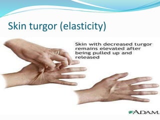 Skin turgor (elasticity)
 