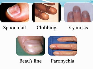 Spoon nail Clubbing Cyanosis
Beau’s line Paronychia
 