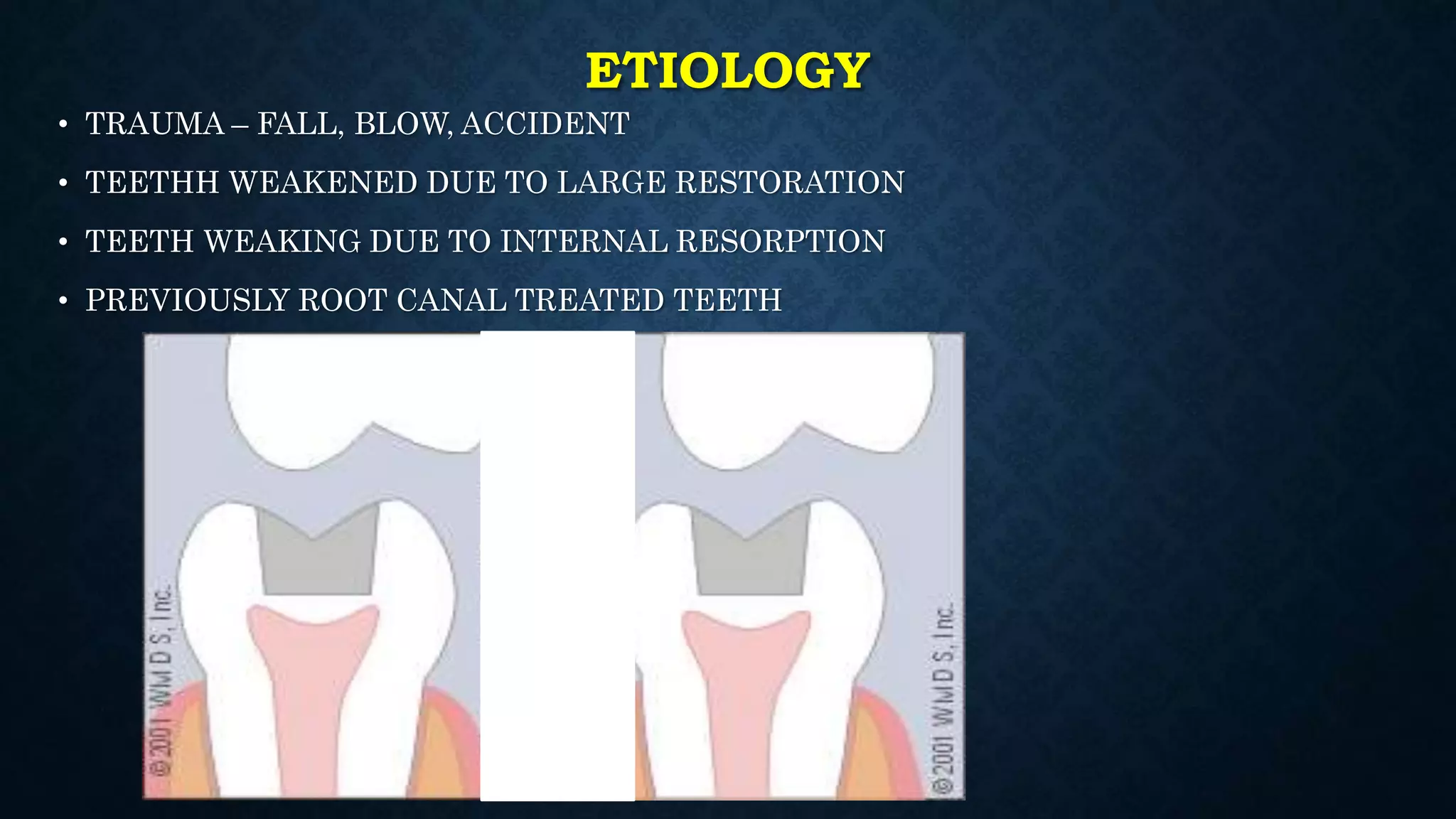 Physical injuries of teeth | PPTX