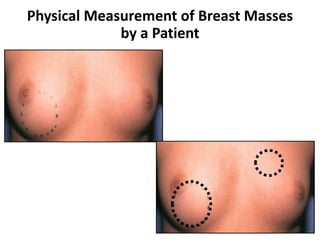 Physical Measurement of Breast Masses
by a Patient
 