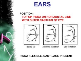 Positioning Pinna physical & behavioral assessment of nweborn.ppt