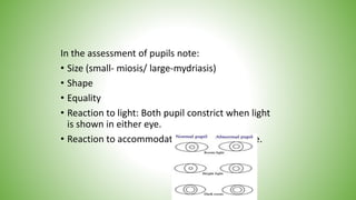 In the assessment of pupils note:
• Size (small- miosis/ large-mydriasis)
• Shape
• Equality
• Reaction to light: Both pupil constrict when light
is shown in either eye.
• Reaction to accommodation and convergence.
 