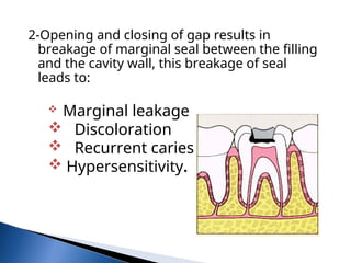 Marginal Opening Comprehensive Overview of Physical Properties of Dental Materials for ...