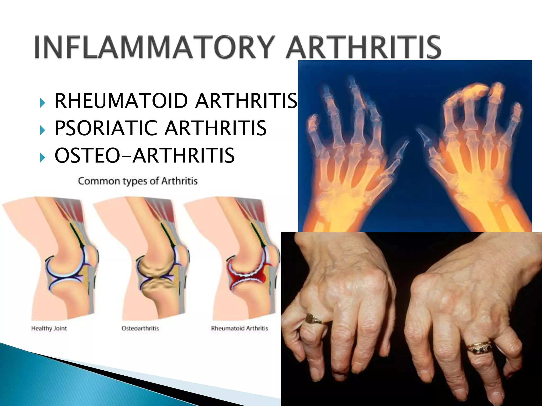 Physical rehabilitation in arthritis | PPTX