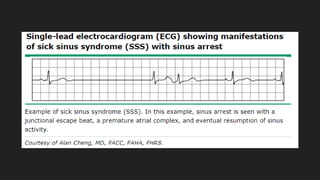 Sick Sinus Syndrome | PPTX