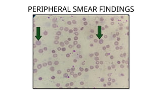 physicon - hereditary spherocytosis.pptx