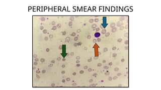 physicon - hereditary spherocytosis.pptx