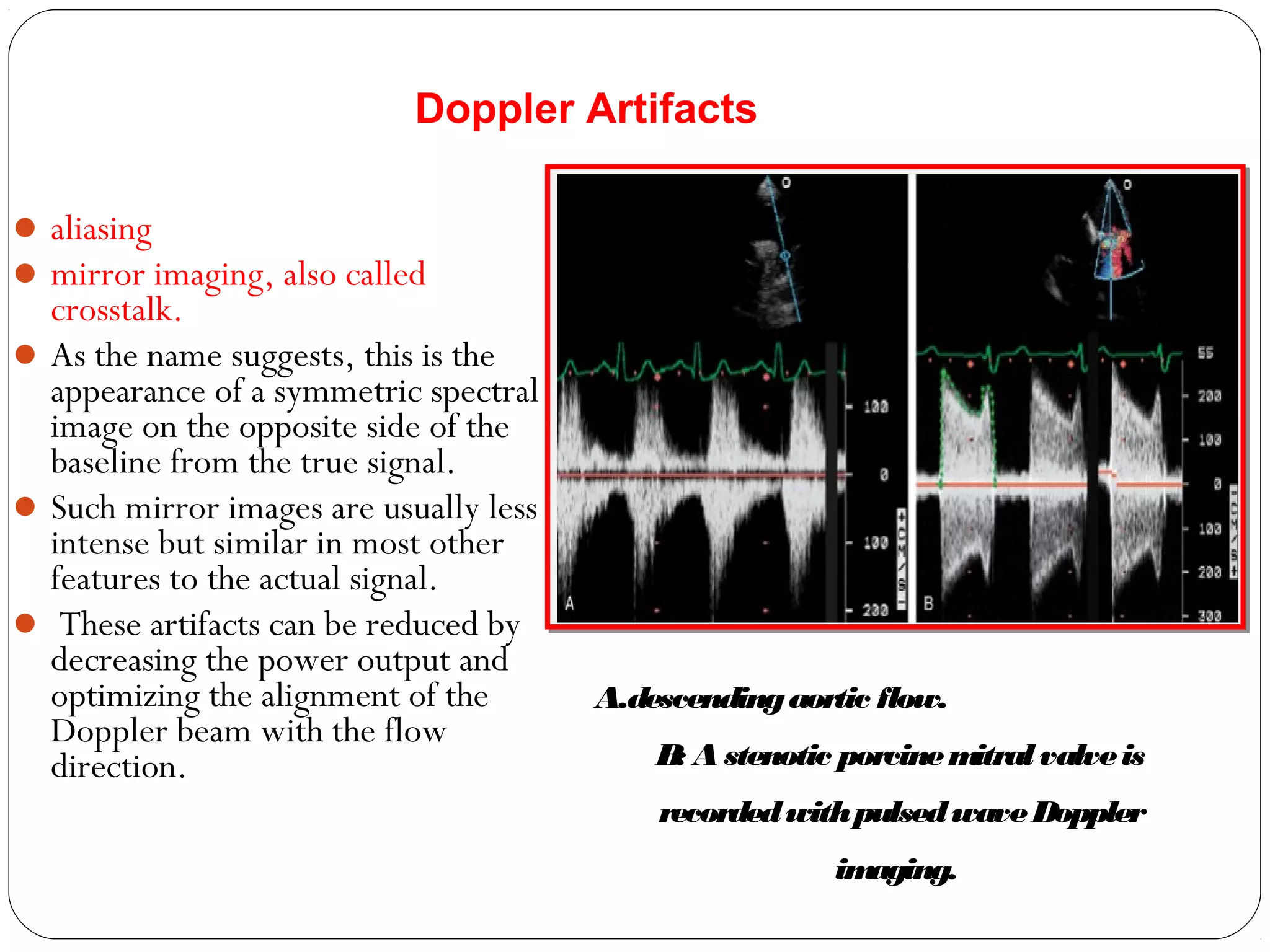 aliasing
mirror imaging, also called
crosstalk.
As the name suggests, this is the
appearance of a symmetric spectral
image on the opposite side of the
baseline from the true signal.
Such mirror images are usually less
intense but similar in most other
features to the actual signal.
 These artifacts can be reduced by
decreasing the power output and
optimizing the alignment of the
Doppler beam with the flow
direction.
Doppler Artifacts
A.descendingaortic flow.
B: A stenotic porcinemitral valveis
recordedwithpulsedwaveDoppler
imaging.
 