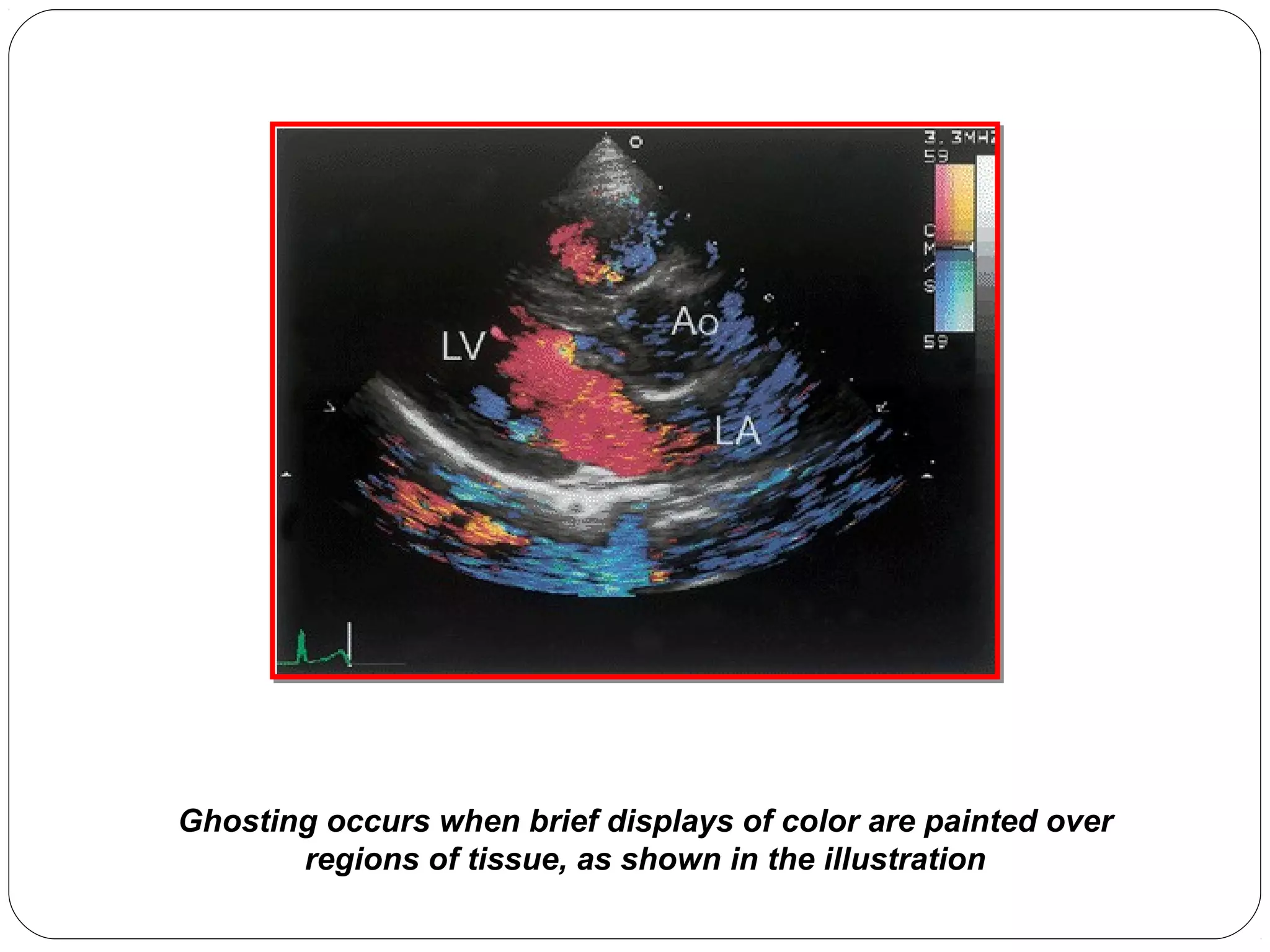 Ghosting occurs when brief displays of color are painted over
regions of tissue, as shown in the illustration
 