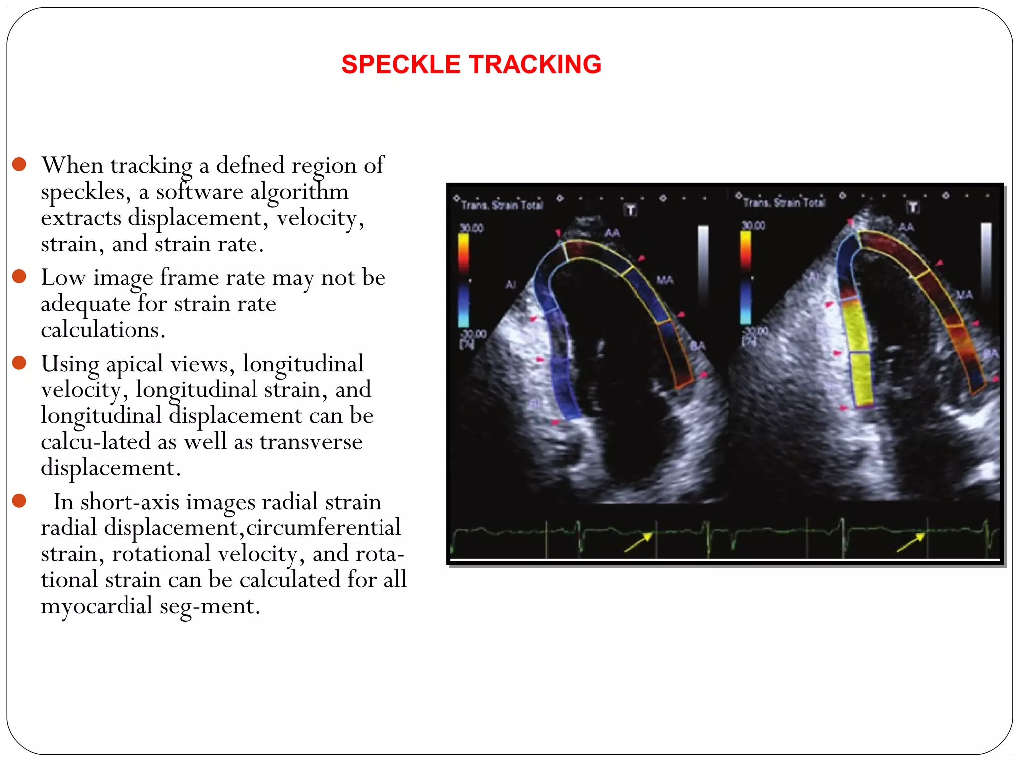  When tracking a defned region of
speckles, a software algorithm
extracts displacement, velocity,
strain, and strain rate.
 Low image frame rate may not be
adequate for strain rate
calculations.
 Using apical views, longitudinal
velocity, longitudinal strain, and
longitudinal displacement can be
calcu-lated as well as transverse
displacement.
 In short-axis images radial strain
radial displacement,circumferential
strain, rotational velocity, and rota-
tional strain can be calculated for all
myocardial seg-ment.
SPECKLE TRACKING
 
