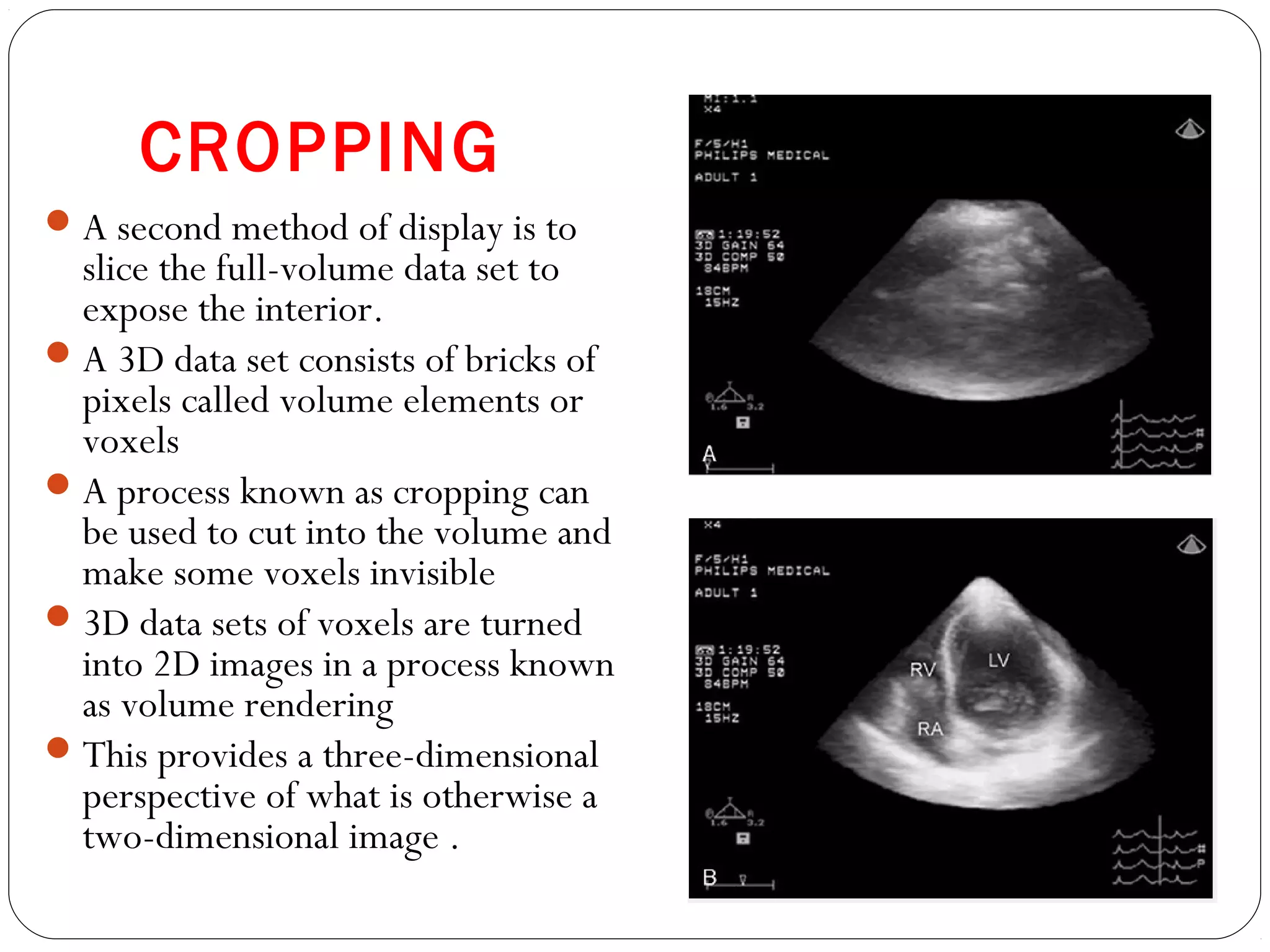 CROPPING
A second method of display is to
slice the full-volume data set to
expose the interior.
A 3D data set consists of bricks of
pixels called volume elements or
voxels
A process known as cropping can
be used to cut into the volume and
make some voxels invisible
3D data sets of voxels are turned
into 2D images in a process known
as volume rendering
This provides a three-dimensional
perspective of what is otherwise a
two-dimensional image .
 