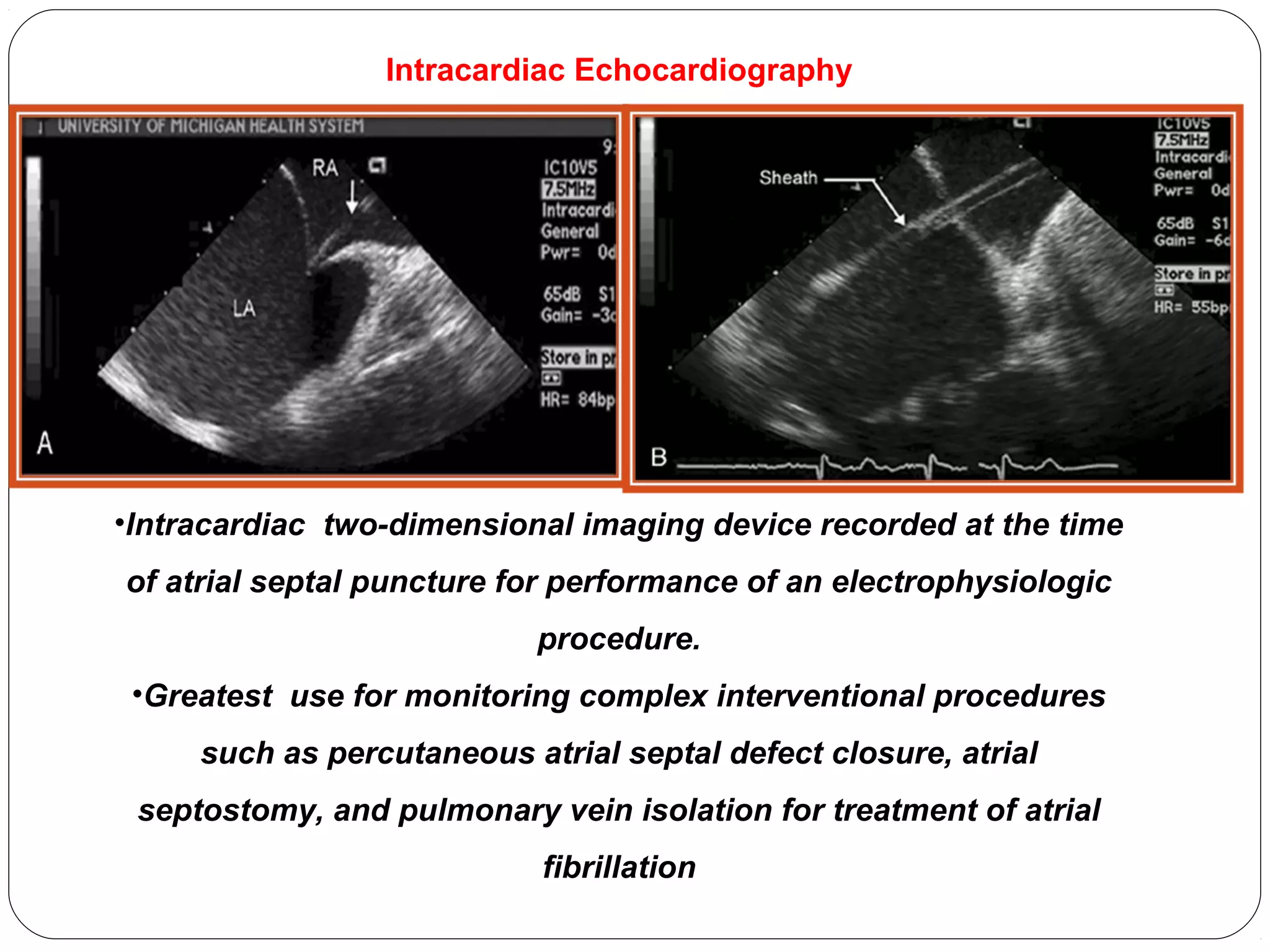 •Intracardiac two-dimensional imaging device recorded at the time
of atrial septal puncture for performance of an electrophysiologic
procedure.
•Greatest use for monitoring complex interventional procedures
such as percutaneous atrial septal defect closure, atrial
septostomy, and pulmonary vein isolation for treatment of atrial
fibrillation
Intracardiac Echocardiography
 