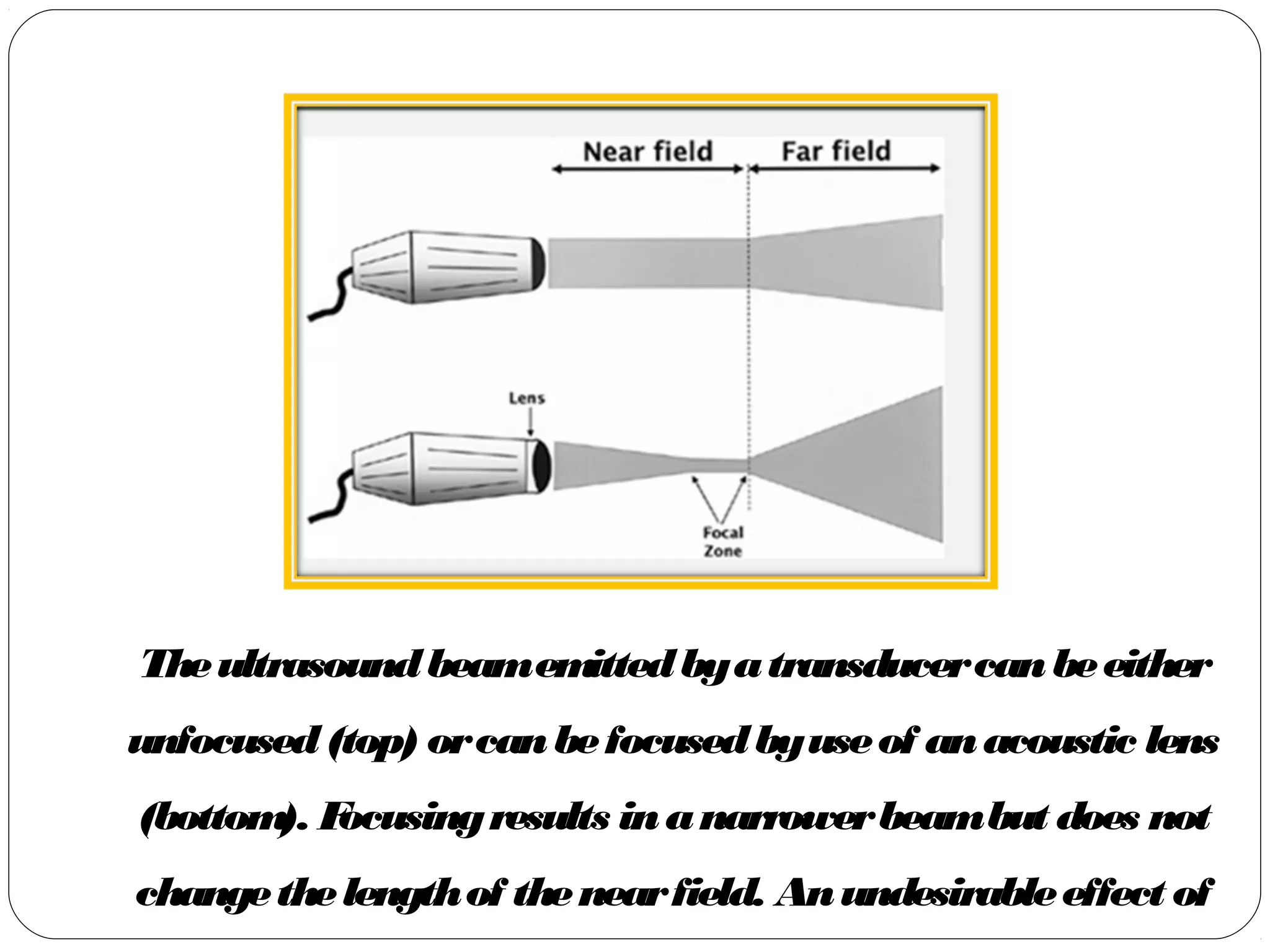 Theultrasoundbeamemittedbyatransducercanbeeither
unfocused(top) orcanbefocusedbyuseof anacoustic lens
(bottom). Focusingresults inanarrowerbeambut does not
changethelengthof thenearfield. Anundesirableeffect of
 