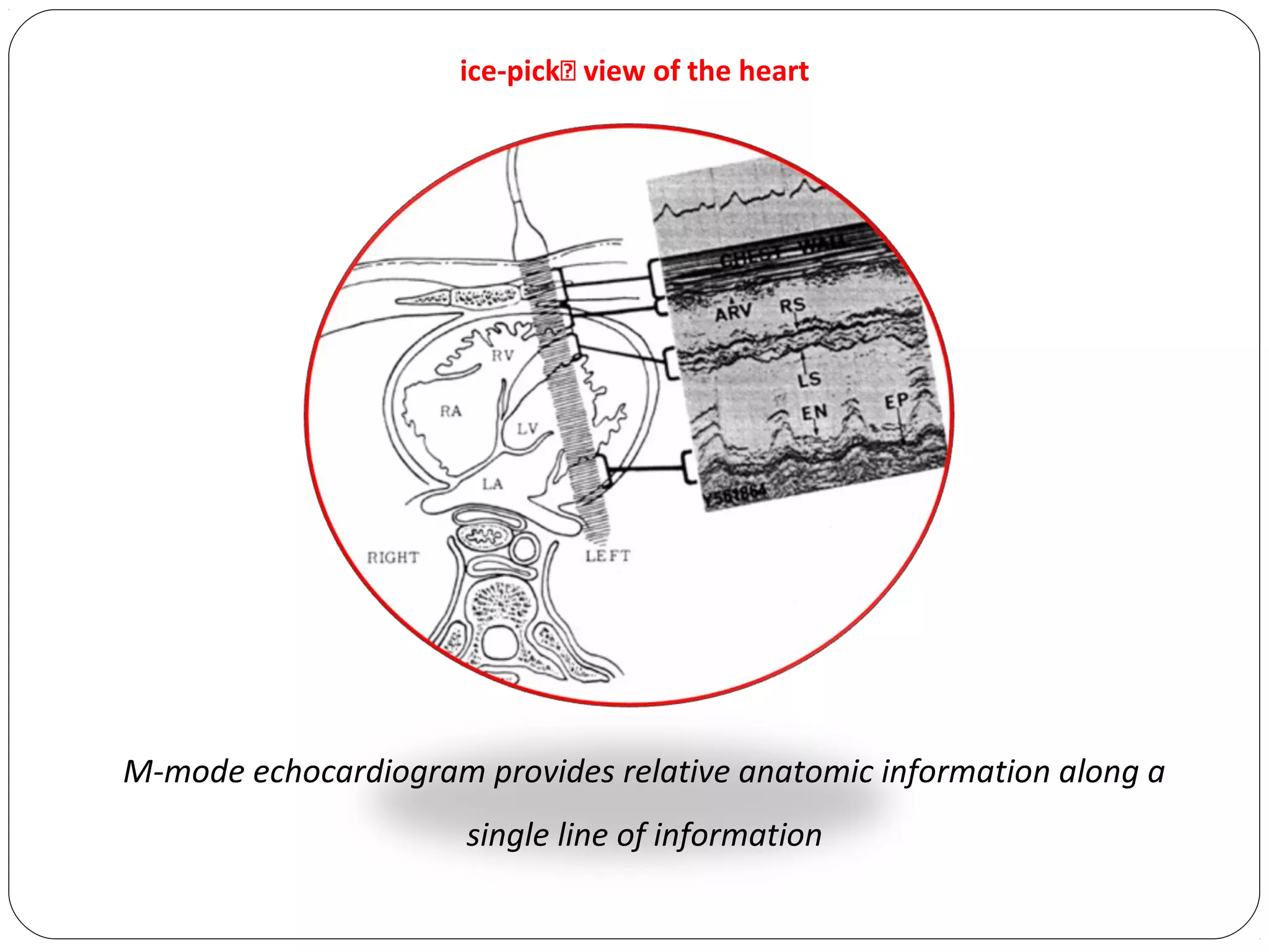 M-mode echocardiogram provides relative anatomic information along a
single line of information
ice-pick view of the heart
 